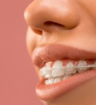 שיניים עקומות - תמונת אווירה